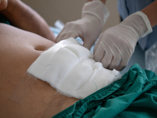 healthcare worker's hands removing gauze from below a patient's navel